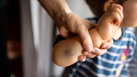 Eine Hand hält den Arm eines Kleinkindes mit einem großen Haematom.